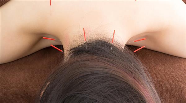 中醫(yī)針灸有何療效？石家莊炎黃針灸推拿學(xué)校為你分享！